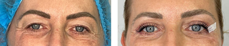 Augenlidstraffung Vorher-Nachher Fotos