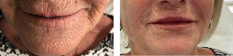 Mesotherapie Vorher Nachher Bilder